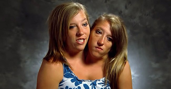 Siamese Twin Girls